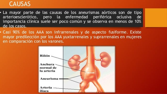 Aneurismas De Aorta Abdominal