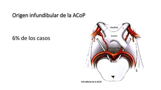 Aneurismas de la arteria comunicante posterior.pptx