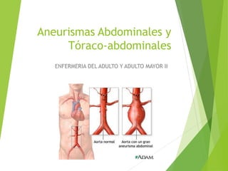 Aneurismas Abdominales y
Tóraco-abdominales
ENFERMERIA DEL ADULTO Y ADULTO MAYOR II
 