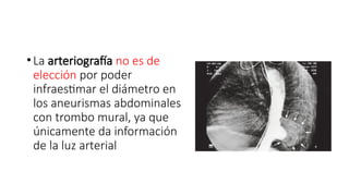 •La arteriografía no es de
elección por poder
infraestimar el diámetro en
los aneurismas abdominales
con trombo mural, ya que
únicamente da información
de la luz arterial
 