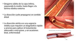 • Desgarro súbito de la capa íntima,
separando la media, hasta llegar a la
lámina elástica externa
• La disección suele propagarse en sentido
distal
• La disección aórtica es una urgencia
médica que requiere un diagnóstico rápido
y preciso para aplicar el tratamiento
adecuado a esta grave, y en ocasiones
letal, enfermedad
 