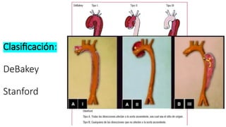 Clasificación:
DeBakey
Stanford
 