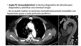 • Angio-TC toracoabdominal: la técnica diagnóstica de elección para
diagnostico y planificar una eventual cirugía
- No se puede realizar en pacientes hemodinámicamente inestables con
hipotensión grave y mala perfusión periférica
 