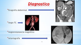 12
Diagnostico
*Ecografía abdominal
*Angio TC
*Angionresonancia magnética
*Arteriografía
 