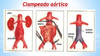 14
Clampeado aórtico
 