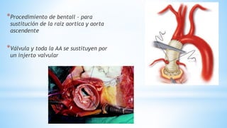 19
*Procedimiento de bentall – para
sustitución de la raíz aortica y aorta
ascendente
*Válvula y toda la AA se sustituyen por
un injerto valvular
 