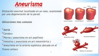 2
Aneurisma
Dilatación anormal localizada en un vaso, ocasionada
por una degeneración de la pared.
Ubicaciones mas comunes
*Aorta
*Cerebro
*Pierna ( aneurisma en art poplítea)
*Intestino ( aneurisma en art mesentérica )
*Aneurisma en la arteria esplénica ubicada en el
Tronco celiaco
 
