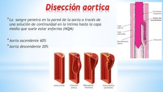 28
Disección aortica
*La sangre penetra en la pared de la aorta a través de
una solución de continuidad en la intima hasta la capa
media que suele estar enferma (NQM)
*Aorta ascendente 60%
*Aorta descendente 20%
 