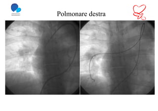 Polmonare destra
 
