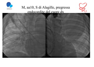M, aa10, S di Alagille, pregressa
   endocardite del cuore dx
 