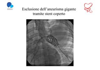 Esclusione dell’aneurisma gigante
      tramite stent coperto
 