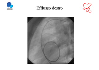 Efflusso destro
 