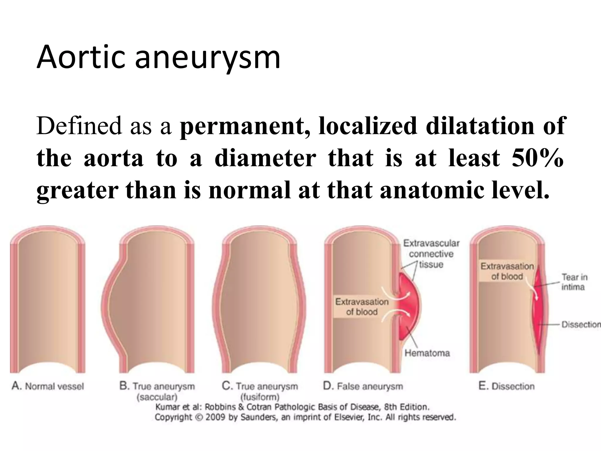 Aneurysm & THORACIC ANEURYSM | PPTX