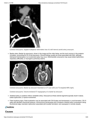 10/4/21, 9:12 PM https://emedicine.medscape.com/article/1161518-print
https://emedicine.medscape.com/article/1161518-print 8/29
Cerebral aneurysms. Sagittal multiplanar reformatted view of a left internal carotid artery aneurysm.
Basilar artery: Basilar tip aneurysms, shown in the image and the video below, are the most common in the posterior
circulation, accounting for 5% of all aneurysms. Clinical findings usually are those associated with SAH, although
bitemporal hemianopsia or an oculomotor palsy may occur. Dolichoectatic aneurysms may cause bulbar dysfunction,
respiratory difficulties, or neurogenic pulmonary edema.
Cerebral aneurysms. Basilar tip aneurysm illustrated on CT scan (left) and T2-weighted MRI (right).
Cerebral aneurysms. Volume-rendered CT angiography of a basilar tip aneurysm.
Vertebral artery or posterior inferior cerebellar artery: Aneurysms at these arterial segments typically result in ataxia,
bulbar dysfunction, or spinal involvement.
False localizing signs: False localization may be associated with CN III palsy and hemiparesis in uncal herniation, CN VI
palsy with elevated intracranial pressure, homonymous hemianopsia due to posterior cerebral artery compression along
the tentorial edge, brainstem dysfunction associated with tonsillar herniation, and vasospasm in remote vessels.
Causes
 