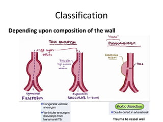 Classification
Depending upon composition of the wall
Trauma to vessel wall
 