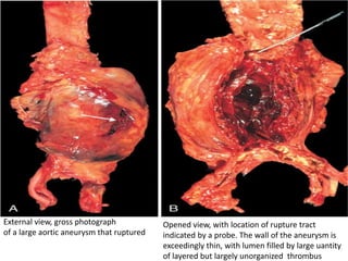 External view, gross photograph
of a large aortic aneurysm that ruptured
Opened view, with location of rupture tract
indicated by a probe. The wall of the aneurysm is
exceedingly thin, with lumen filled by large uantity
of layered but largely unorganized thrombus
 
