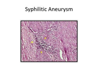 Syphilitic Aneurysm
 