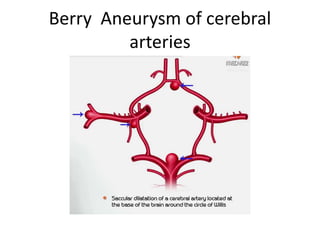 Berry Aneurysm of cerebral
arteries
 