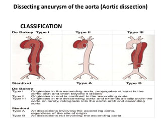 Dissecting aneurysm of the aorta (Aortic dissection)
CLASSIFICATION
 