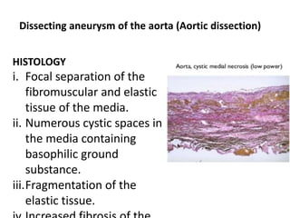 Dissecting aneurysm of the aorta (Aortic dissection)
HISTOLOGY
i. Focal separation of the
fibromuscular and elastic
tissue of the media.
ii. Numerous cystic spaces in
the media containing
basophilic ground
substance.
iii.Fragmentation of the
elastic tissue.
 