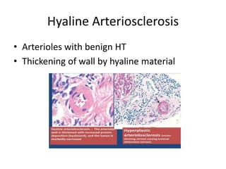 Hyaline Arteriosclerosis
• Arterioles with benign HT
• Thickening of wall by hyaline material
 