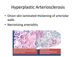 Hyperplastic Arteriosclerosis
• Onion skin laminated thickening of arteriolar
walls
• Necrotizing arteriolitis
 