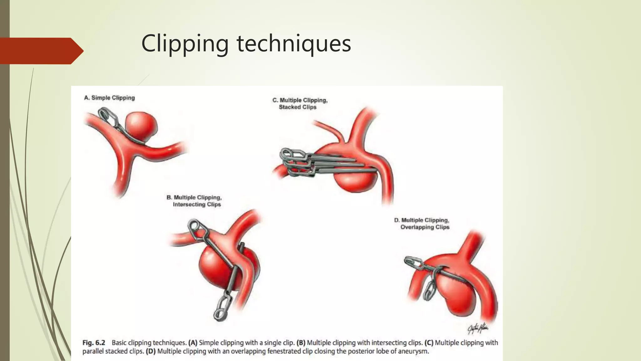 Aneurysm clips /clipology | PPTX