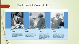 Evolution of Yasargil clips
 