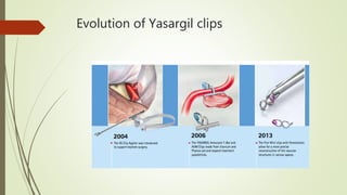 Evolution of Yasargil clips
 