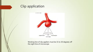 Clip application
Working line of clip appliers must be 15 to 30 degrees off
the sight line of microscope
 