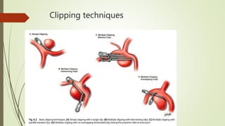 Clipping techniques
 