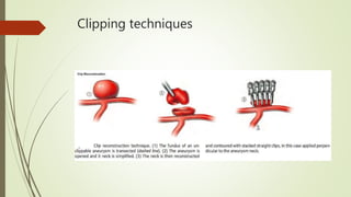 Clipping techniques
 