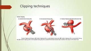 Clipping techniques
 