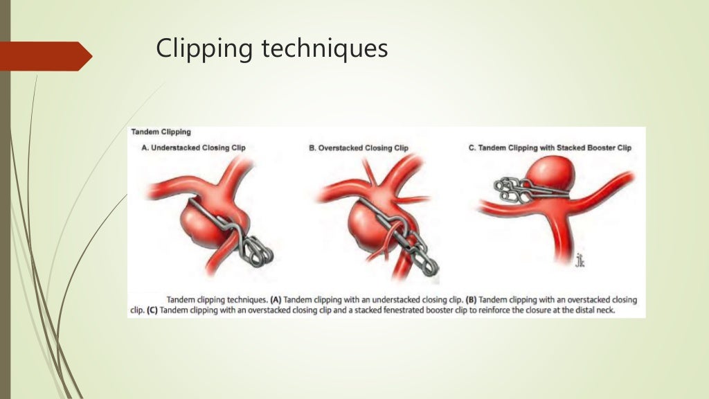 Aneurysm clips /clipology
