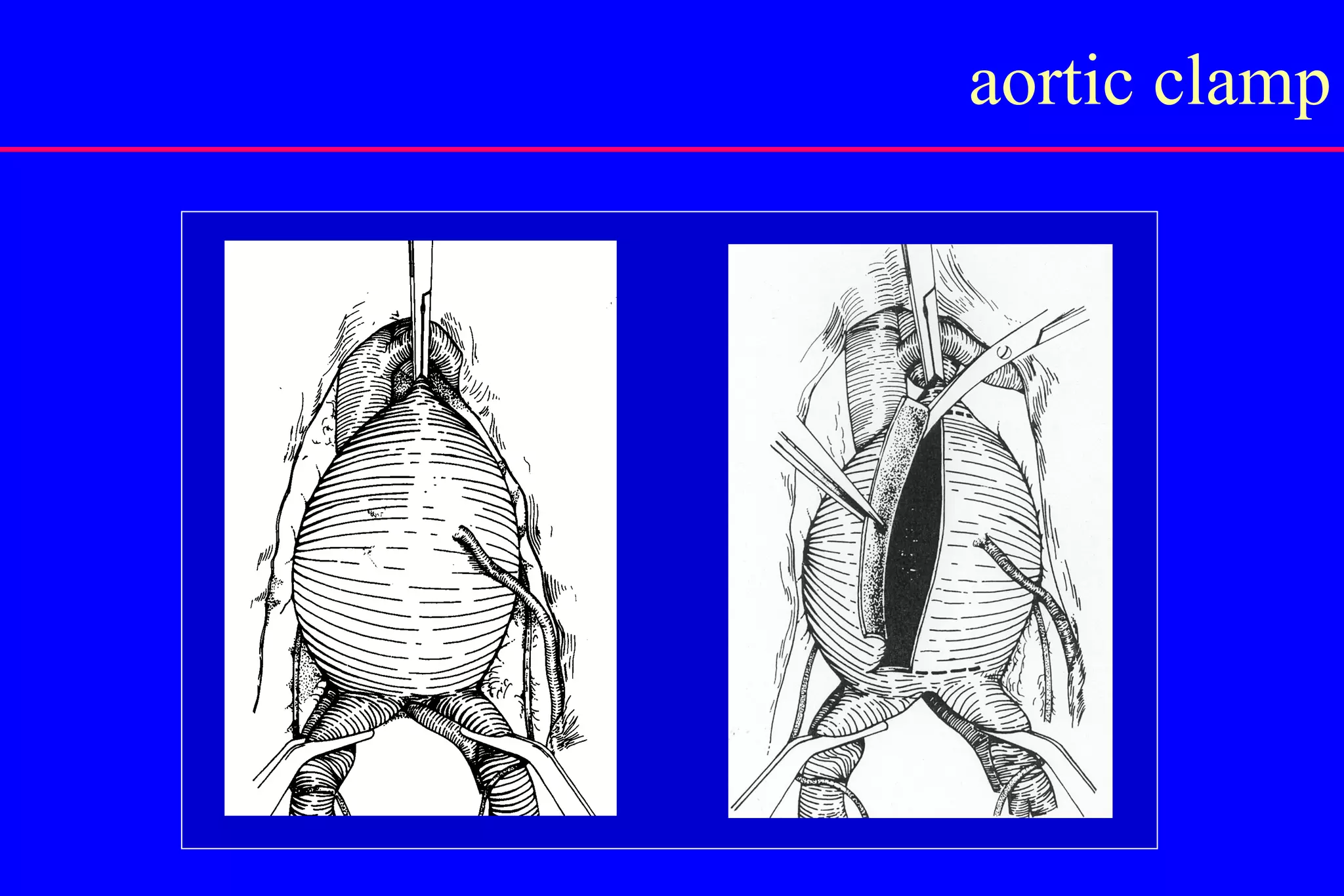 Abdominal Aortic Aneurysm | PPT