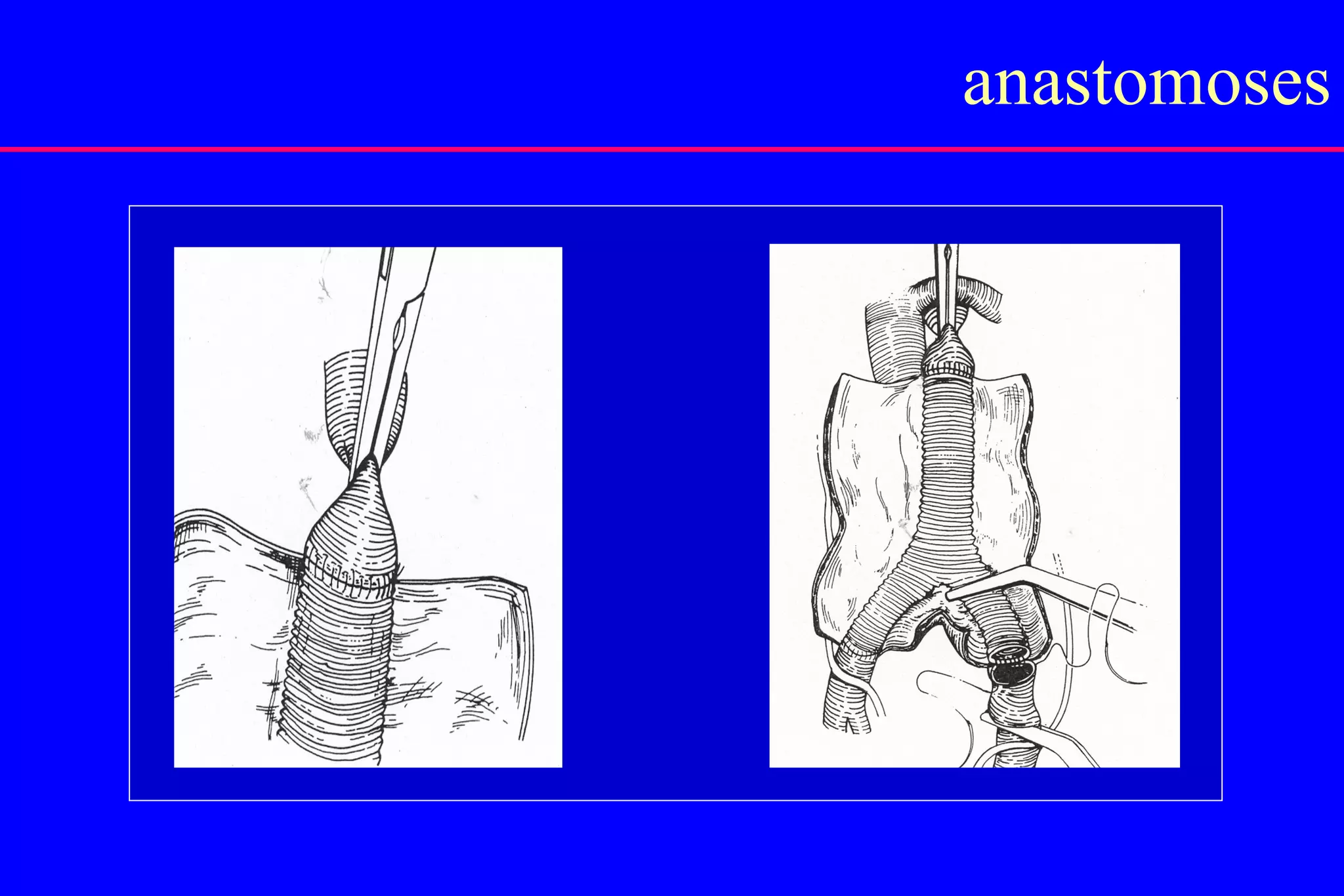 Abdominal Aortic Aneurysm | PPT