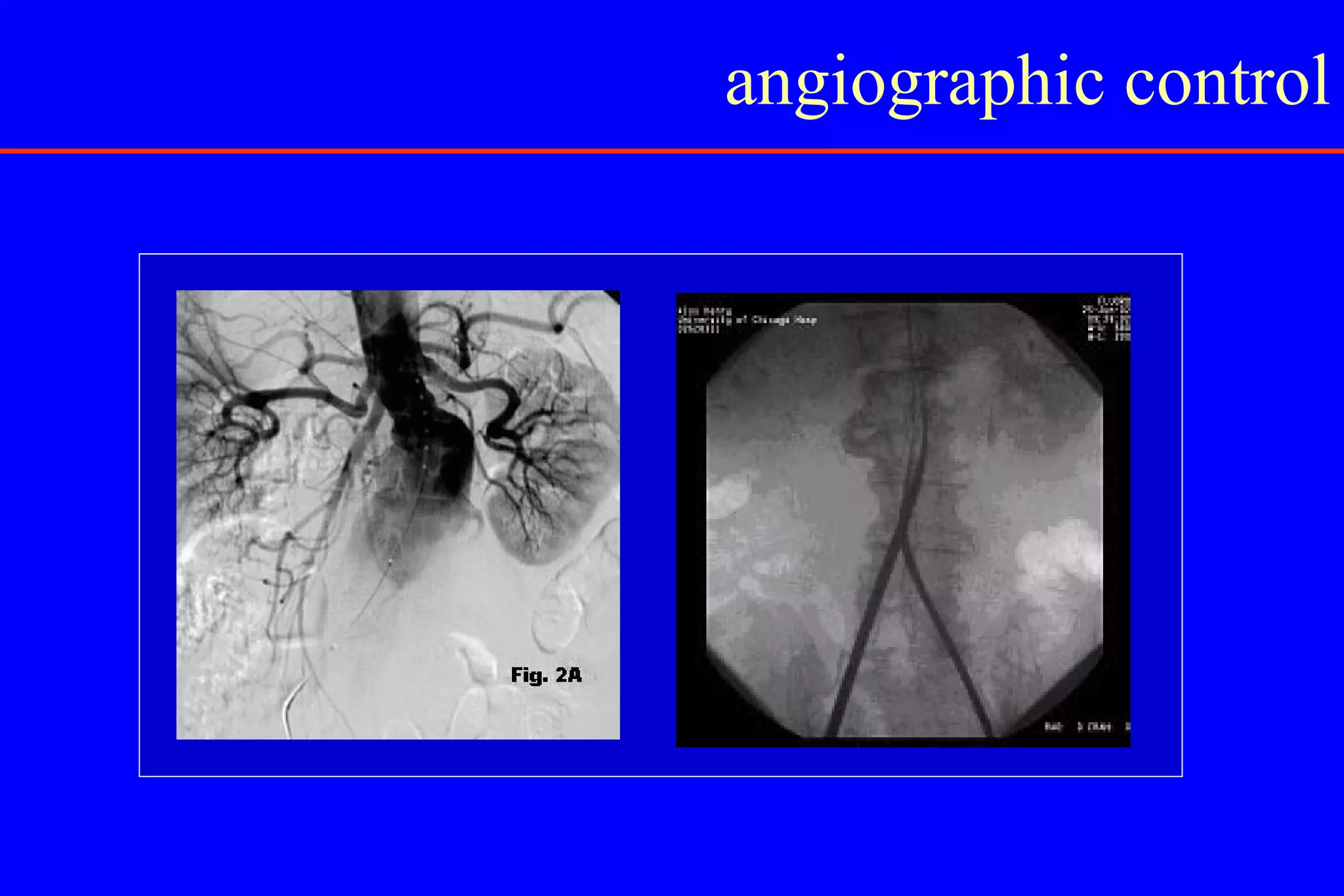 Abdominal Aortic Aneurysm | PPT