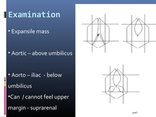 Examination
• Expansile mass
• Aortic – above umbilicus
• Aorto – iliac - below
umbilicus
•Can / cannot feel upper
margin - suprarenal
 