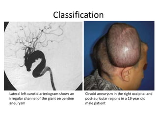 Classification
Lateral left carotid arteriogram shows an
irregular channel of the giant serpentine
aneurysm
Cirsoid aneurysm in the right occipital and
post-auricular regions in a 19 year old
male patient
 
