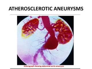 ATHEROSCLEROTIC ANEURYSMS
 