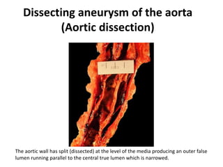 Dissecting aneurysm of the aorta
(Aortic dissection)
The aortic wall has split (dissected) at the level of the media producing an outer false
lumen running parallel to the central true lumen which is narrowed.
 