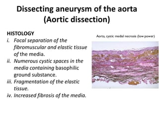 Dissecting aneurysm of the aorta
(Aortic dissection)
HISTOLOGY
i. Focal separation of the
fibromuscular and elastic tissue
of the media.
ii. Numerous cystic spaces in the
media containing basophilic
ground substance.
iii. Fragmentation of the elastic
tissue.
iv. Increased fibrosis of the media.
 