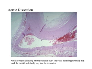 Block Dissection Aneurysms and dissections | PPT