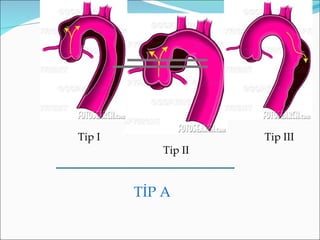 Tip I               Tip III
           Tip II



        TİP A
 