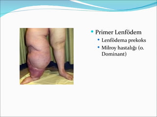  Primer Lenfödem
   Lenfödema prekoks
   Milroy hastalığı (o.
   Dominant)
 