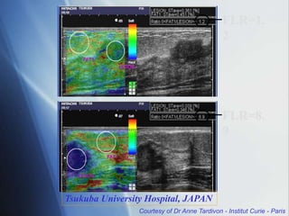 FLR=1.
2
FLR=8.
9
Tsukuba University Hospital, JAPAN
Courtesy of Dr Anne Tardivon - Institut Curie - Paris
 