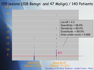 5
20
25
30
35
40
15
10
4.3
cut-off = 4.3
Specificity = 88.8%
Sensitivity = 89.4%
Exactitude = 89.0%
Area under curve = 0.906
FLR
BENIGN MALIGN
(Mean: 2.95) (Mean: 11.61)
155 lesions (108 Benign and 47 Malign) / 140 Patients
Courtesy of Dr Anne Tardivon - Institut Curie - Paris
 