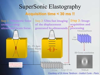 4% -1% Agar-
Gelatin Elastic
phantom
~ 100 µs
Step 1: Volumetric force
creation using
ultrasound beam focus
1D Cross-correlation
Step 3: Image
acquisition and
processing
Ultrasound beam
US
images
Uz(x,t)
Step 2: Ultra fast imaging
of the displacement
generated by ultrasounds
Texp=20 ms
~ 0.3 ms
Acquisition time < 30 ms !!
Courtesy of Dr Anne Tardivon - Institut Curie - Paris
SuperSonic Elastography
 