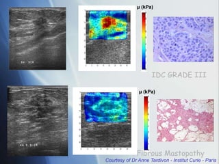 µ (kPa)
µ (kPa)
IDC GRADE III
Fibrous Mastopathy
Courtesy of Dr Anne Tardivon - Institut Curie - Paris
 
