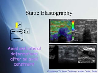 Axial and lateral
deformations
after an axial
constraint


Courtesy of Dr Anne Tardivon - Institut Curie - Paris
Static Elastography
 